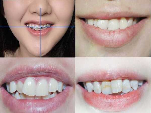 Niềng răng sai cách ảnh hưởng đến khuôn mặt như thế nào?