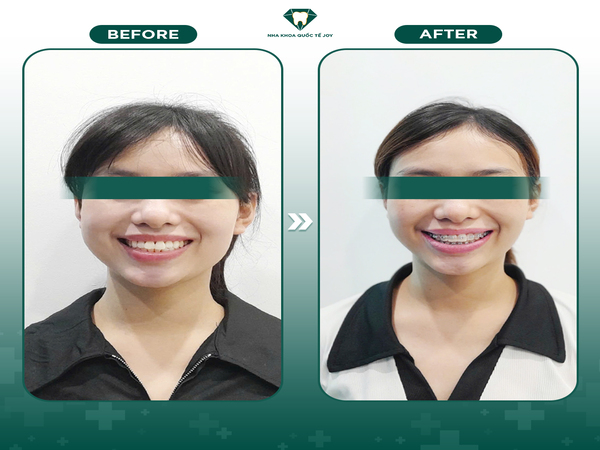 Khuôn mặt thay đổi đáng kể trước và sau khi niềng răng