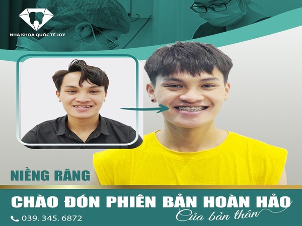 Tự tin với vẻ ngoài của bản thân sau khi niềng răng