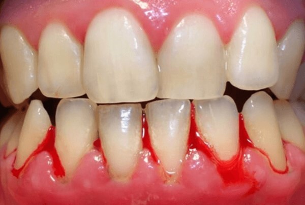 Bao lâu nên cạo vôi răng để tránh viêm nướu và chảy máu chân răng 