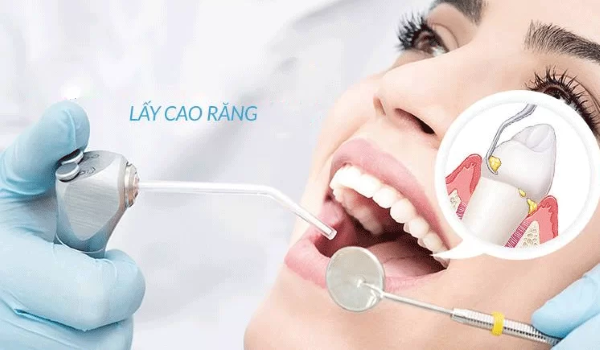 Tiêu chí chọn lựa địa chỉ lấy cao răng - Bao lâu nên cạo vôi răng?