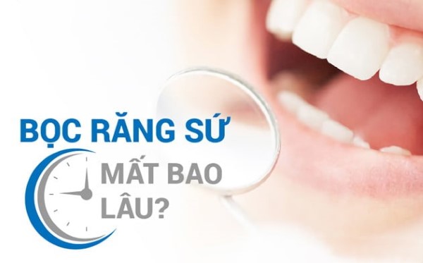 Thời gian thực hiện bọc răng sứ tùy vào tình trạng răng