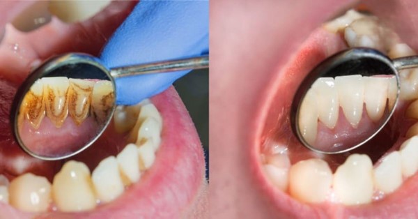 Ảnh hưởng của mảng bám đến sức khỏe răng miệng