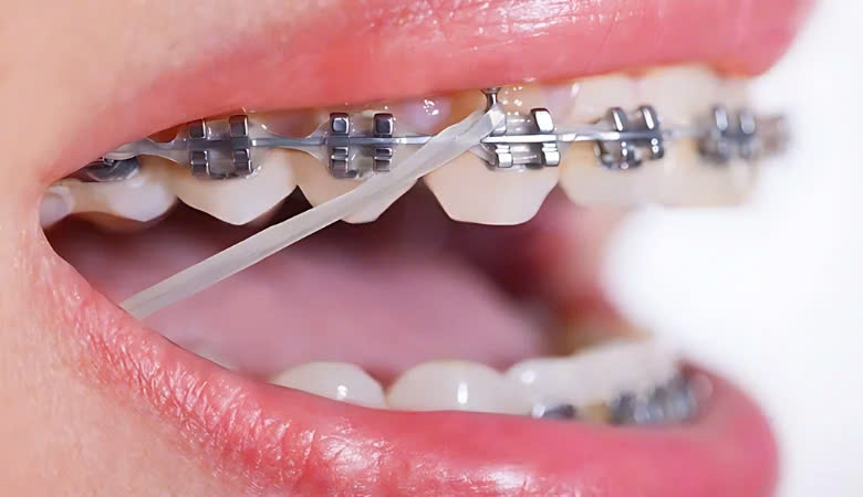 Đóng khoảng trong niềng răng mất bao lâu?