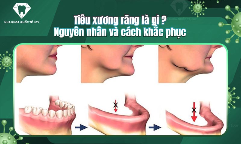 Tiêu xương răng là gì? Nguyên nhân và cách khắc phục
