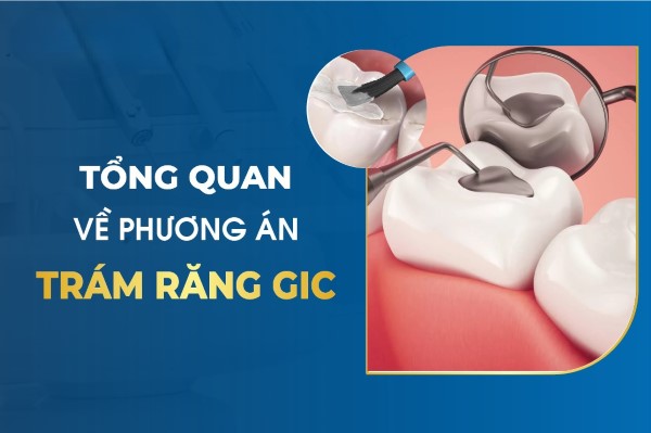 Trám răng GIC là gì? Trám răng GIC là gì?