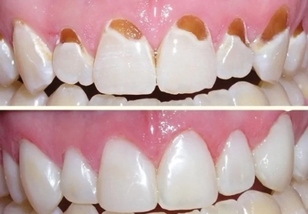 Ưu điểm của trám răng GIC là gì? Ưu điểm của trám răng GIC là gì?