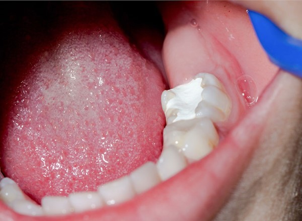 Nhược điểm của trám răng GIC là gì? Nhược điểm của trám răng GIC là gì?