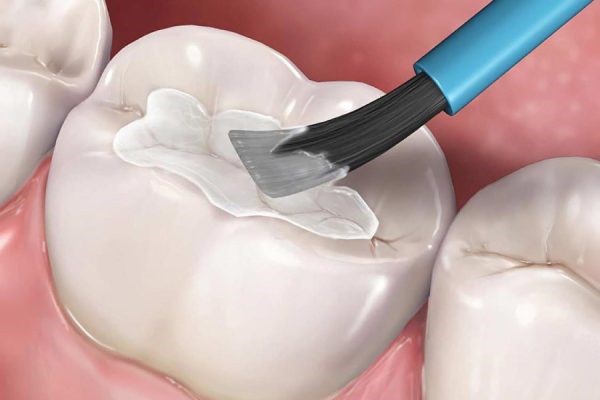 Các câu hỏi thường gặp liên quan đến trám răng GIC là gì? Các câu hỏi thường gặp liên quan đến trám răng GIC là gì?