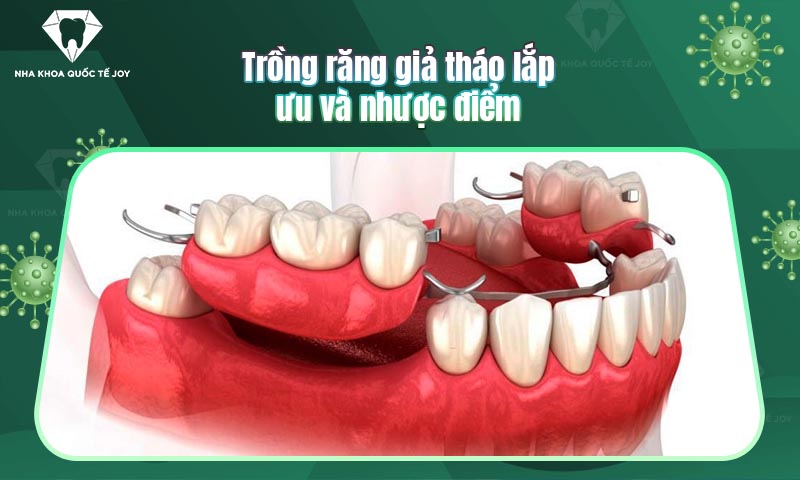 Trồng răng giả tháo lắp là gì? Ưu nhược điểm và điều lưu ý