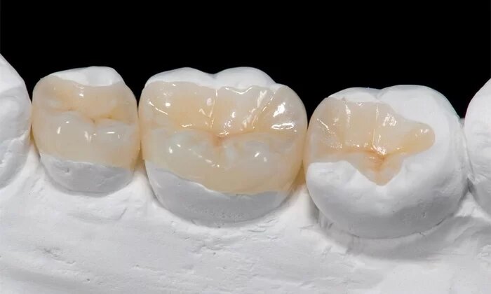 Lý do cần sử dụng mão răng?