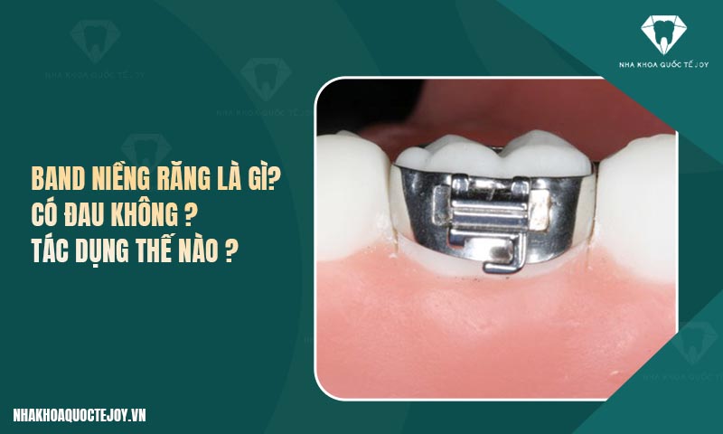 Band niềng răng là gì? Có đau không? Tác dụng thế nào?