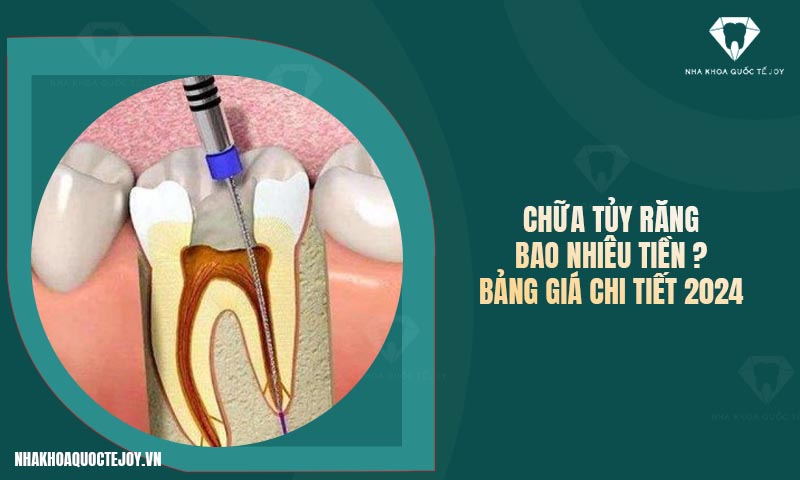 Chữa tủy răng bao nhiêu tiền? Bảng giá chi tiết 2024