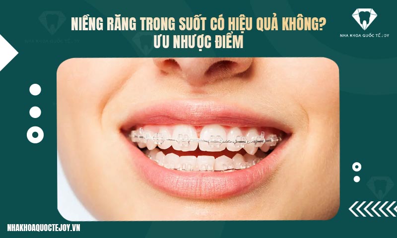 Niềng răng trong suốt có hiệu quả không? Ưu nhược điểm