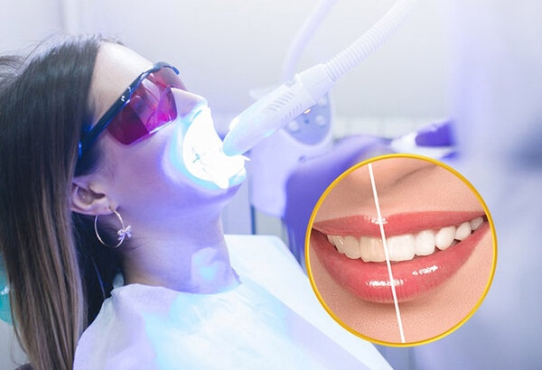 Tẩy trắng răng tại nha khoa quốc tế Joy