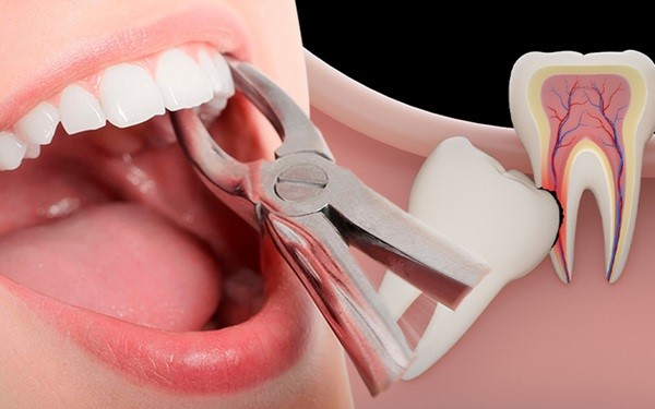Nhổ răng khôn để không ảnh hưởng đến các răng kế cận