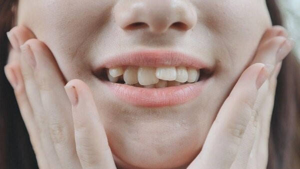 Răng mọc chồi là gì?
