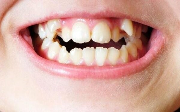 Hình ảnh nhận biết răng mọc chồi 3