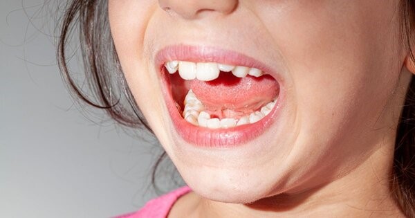Hình ảnh nhận biết răng mọc chồi 4