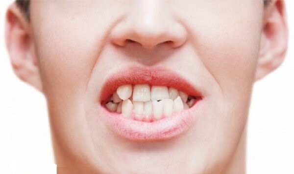 Răng mọc chồi gây mất thẩm mỹ cho khuôn mặt