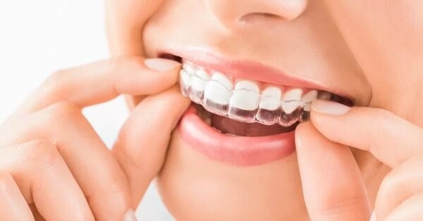 Niềng răng trong suốt