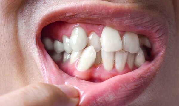 Hình ảnh nhận biết răng mọc chồi 1