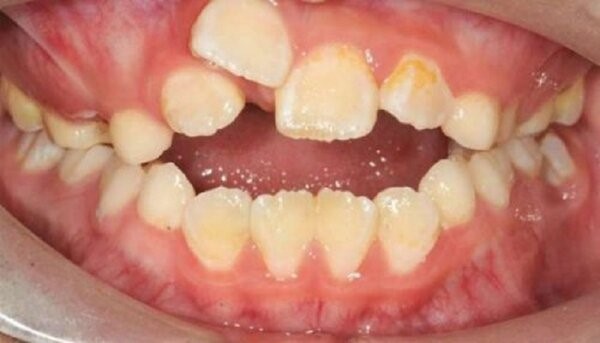 Hình ảnh nhận biết răng mọc chồi 2