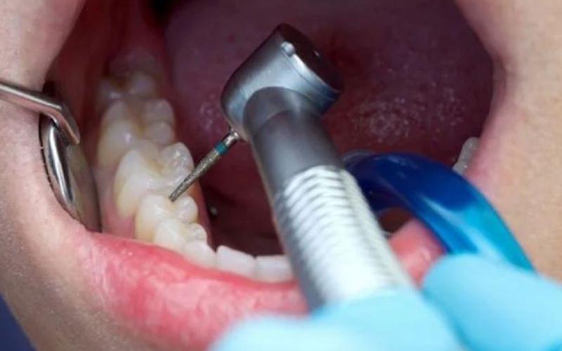 Trám răng mất bao lâu hoàn thành? Những điều cần quan tâm Trám răng mất bao lâu hoàn thành? Những điều cần quan tâm