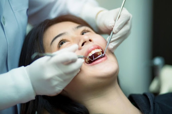 Trám răng mất bao lâu thời gian? Trám răng mất bao lâu thời gian?