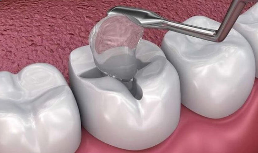 Trám răng mất bao nhiêu thời gian phụ thuộc vào yếu tố nào? Trám răng mất bao nhiêu thời gian phụ thuộc vào yếu tố nào?