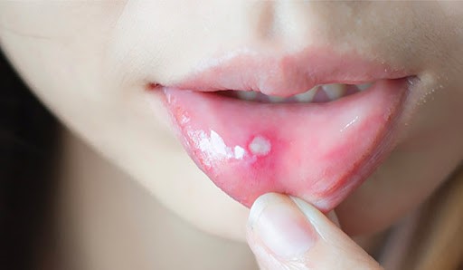 Lưu ý khi chữa nhiệt miệng tại nhà