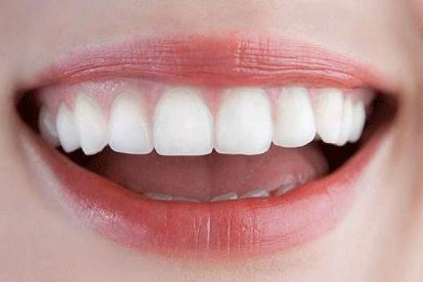 Lợi ích khi làm răng hết hô