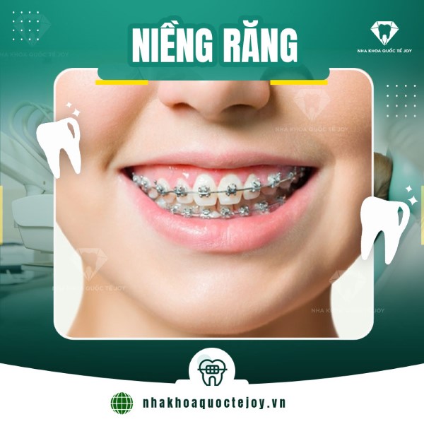Niềng răng là một trong những phương pháp giúp điều chỉnh tình trạng hô răng hiệu quả nhất
