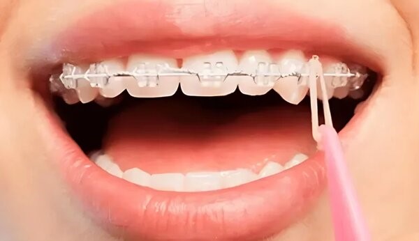 Cách đeo thun liên hàm