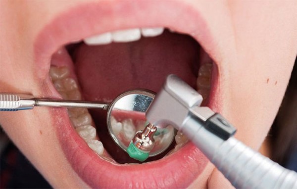 Điều trị mùi hôi ở kẽ răng bằng công nghệ nha khoa tiên tiến