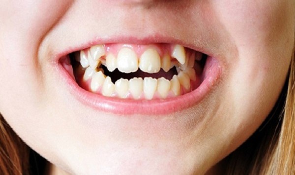 Răng lòi sĩ là gì? Nguyên nhân và giải pháp khắc phục hiệu quả 7 Răng lòi sĩ