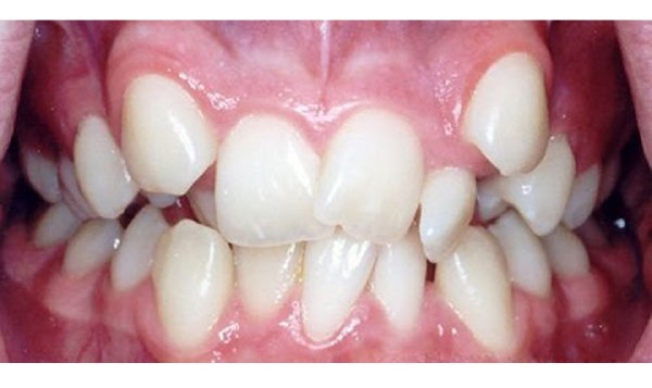 Răng lòi sĩ là gì? Nguyên nhân và giải pháp khắc phục hiệu quả 8 Một số vấn đề về chức năng miệng và răng cũng có thể dẫn đến răng lòi sĩ