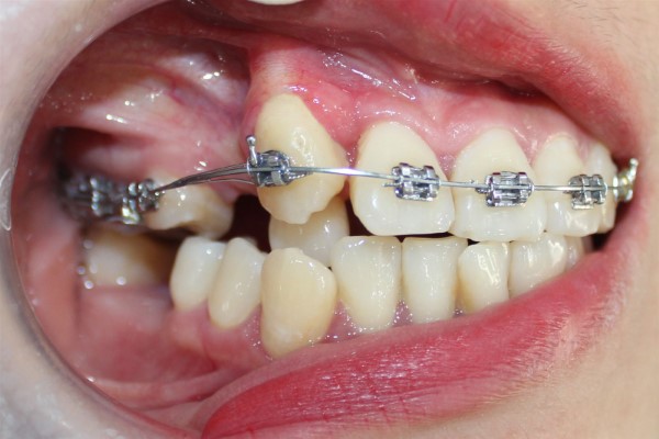 Răng lòi sĩ là gì? Nguyên nhân và giải pháp khắc phục hiệu quả 11 Niềng răng chỉnh hình