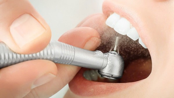 Mài răng cửa có đau không? Tất tần tật về quy trình mài răng cửa 11 Quy trình mài răng cửa tại Nha Khoa Quốc Tế JOY