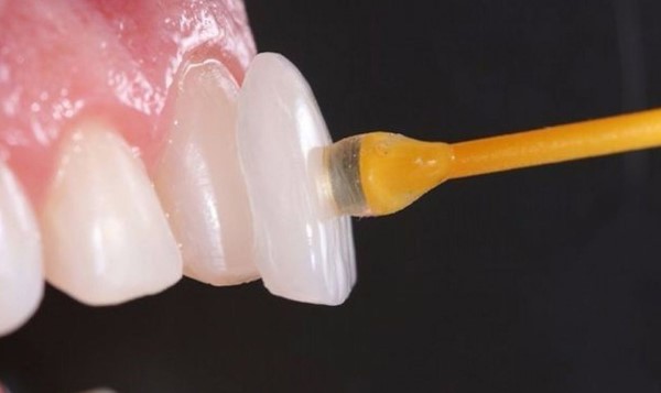 Mài răng cửa có đau không? Tất tần tật về quy trình mài răng cửa 13 Một số tiêu chuẩn mài nhỏ răng cửa phải đảm bảo
