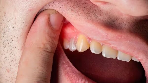 Mọc răng khôn có thể gây ra nhiều vấn đề về răng miệng