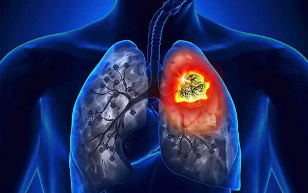 Nhổ nước bọt ra máu có thể là dấu hiệu của tổn thương ở phế quản