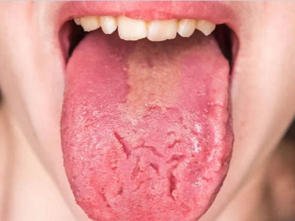Tình trạng nứt lưỡi