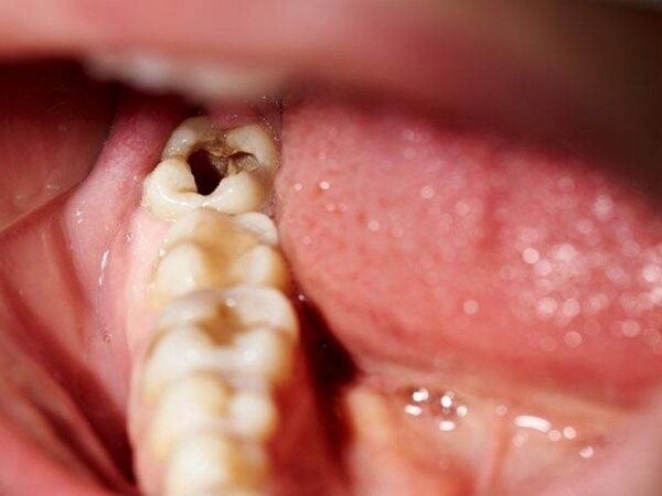 Răng bị sâu lỗ to có trám được không? Những điều cần lưu ý 4 Tình trạng răng sâu lỗ to