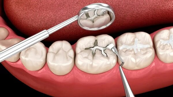 Răng bị sâu lỗ to có trám được không? Quy trình thực hiện trám răng sâu lỗ to Răng bị sâu lỗ to có trám được không? Quy trình thực hiện trám răng sâu lỗ to