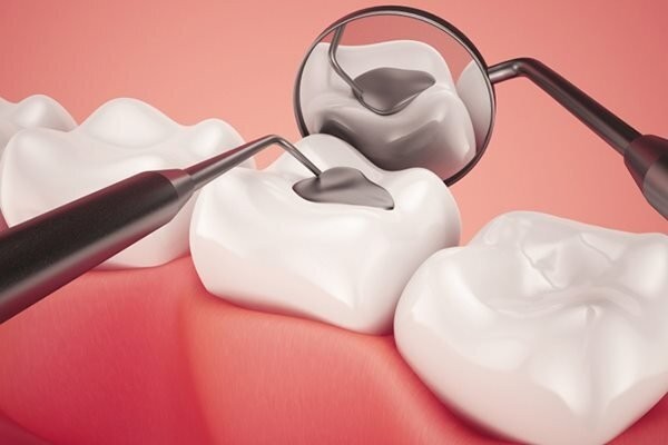 Răng bị sâu lỗ to có trám được không? Răng bị sâu lỗ to có trám được không?