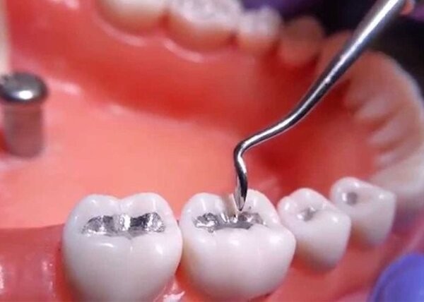 Răng bị sâu lỗ to có trám được không? Những điều cần lưu ý Răng bị sâu lỗ to có trám được không? Những điều cần lưu ý