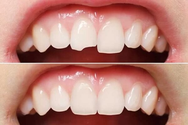 Trám răng cửa bao nhiêu tiền? Những điều cần lưu ý 8 Trám răng cửa ở tình trạng nhẹ