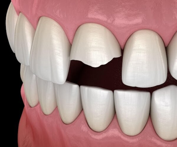 Trám răng cửa bao nhiêu tiền? Những điều cần lưu ý 9 Trám răng cửa bao nhiêu tiền