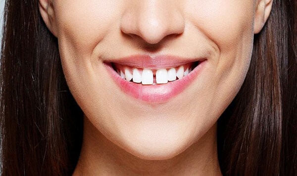 Chi phí trám răng thưa phụ thuộc nhiều yếu tố